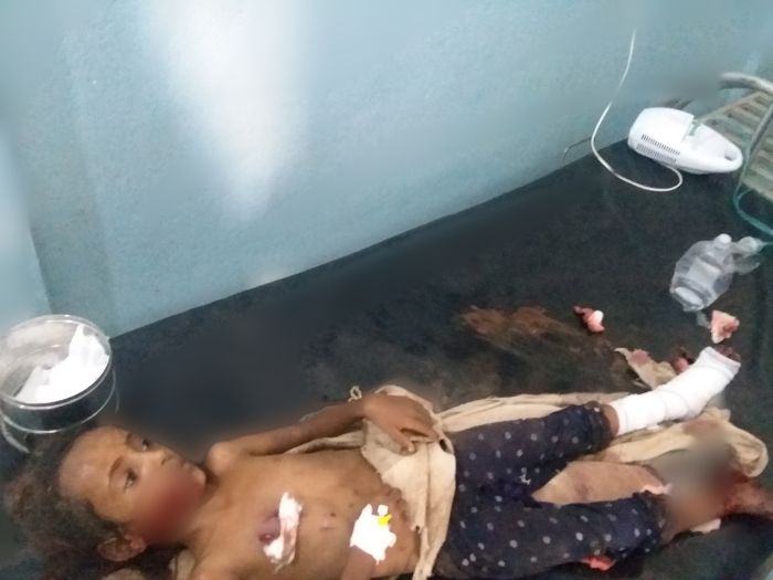 الحديدة.. انفجار لغم حوثي محرم دولياً يسفر عن إصابة طفلتين وامرأة